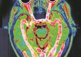 Operation cast head: scan of a human brain